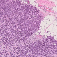 浸潤性乳管癌